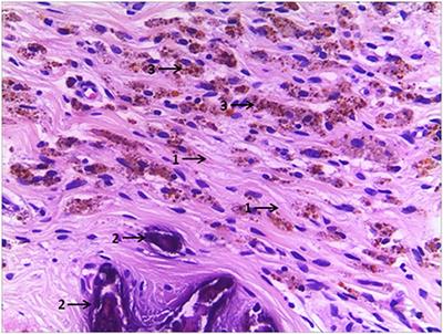 Histopathological Features of Vanishing Testes in 332 Boys: What Is Its Significance? A Retrospective Study From a Tertiary Hospital